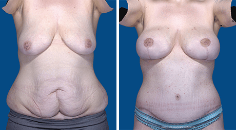 Oregon Plastic Surgeons  Having a Tummy Tuck After Weight Loss